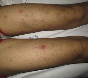 Nódulos eritematosos en ambos muslos en un eritema nudoso leproso (leprorreacción de tipo ii).