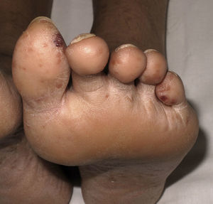 Púrpura distal en un eritema nudoso leproso (leprorreacción de tipo ii).