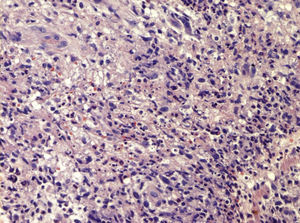Infiltrado linfocítico, neutrofílico e histiocitario en dermis profunda en un eritema nudoso leproso (H-E, ×40).