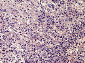 Infiltrado linfocítico, neutrofílico e histiocitario en dermis profunda en un eritema nudoso leproso (H-E, ×40).