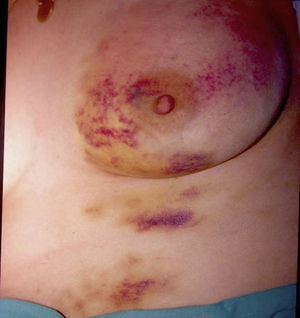 Hematomas dolorosos en una mujer de 36 años. Importante cuadro psicopatológico.