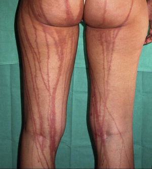 Cuadro provocado en una cabina de bronceado por aplicación de líquido fotosensibilizante.