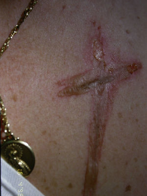 Ampolla por fricción de aspecto lineal formando una cruz.