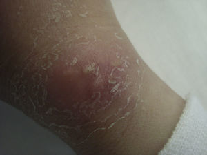 Paniculitis en la muñeca y en el dorso de las manos producida por inyecciones de un material de tipo silicona.