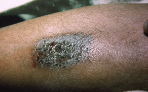 Paniculitis en la pierna de una novicia de un convento.
