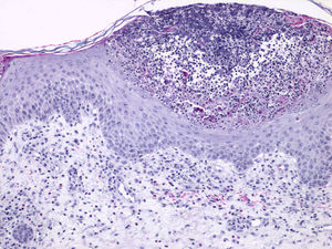 Pústula subcórnea e infiltrado perivascular de linfocitos y eosinófilos (H-E × 40).
