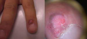 Lesión periungueal exofítica, de coloración rojo-grisácea y superficie hiperqueratósica.