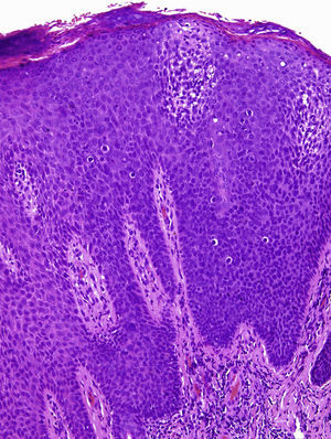 Epidermis hiperplásica, con pérdida de la arquitectura celular normal, atipia citológica moderada, disqueratosis y coilocitos (H-E, ×40).