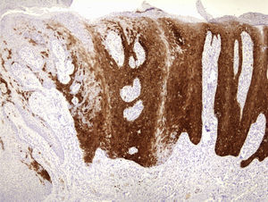 Sobreexpresión de la proteína de supresión tumoral P16.
