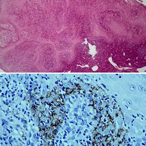 Biopsia de la lesión anterior. Imagen superior (tinción hematoxilina-eosina × 50) donde se aprecia un intenso infiltrado inflamatorio con predominio de células plasmáticas. En la parte inferior la misma biopsia con IHQ (× 400) donde se observa la infiltración de treponemas que aparecen como estructuras arrosariadas marronáceas.