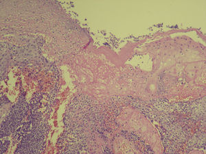 Histología: lóbulos de células basaloides con maduración hacia la luz y formación de células fantasmas. Hematoxilina eosina (100x).