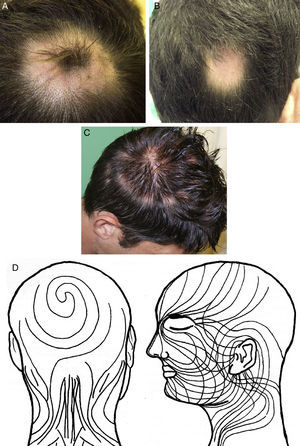 A. Placa alopécica de distribución anular localizada en el vértex. B. Placa alopécica que simulaba una alopecia areata. C. Placa alopécica de distribución arqueada que parece seguir las líneas de Blaschko. D. Patrón propuesto por Happle para describir la distribución de las líneas de Blaschko en el cuero cabelludo.