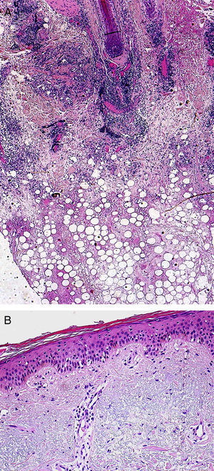 A. Infiltrado de predominio linfocitario en la dermis profunda y el tejido adiposo, con necrosis hialina de la grasa (hematoxilina-eosina ×40). B. Cambios vacuolares en la capa basal de la epidermis (hematoxilina-eosina ×200).
