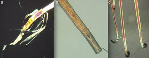 Resultado de una mala toma de muestra. A. Membranas desflecadas. B. Extremo proximal cortado. C. Aspecto distrófico del pelo. Observación con microscopio optico de luz polarizada (x40 a y b) (x10 c).