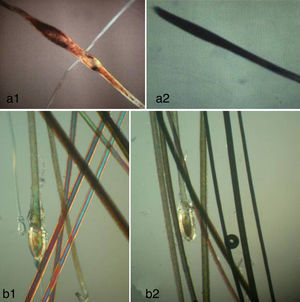 Observación del tallo: uniformidad. a1). Pseudomoniletrix. a2). Tricorexis nodosa en la alopecia areata. b1 y b2). Diferencias en los tallos en una alopecia androgenética con cabellos en telogén (los más cortos y más finos).