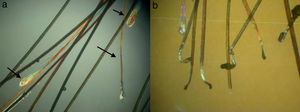 Alopecia androgenética: diferencia entre los diámetros de los tallos, cabellos en telogén más finos y cortos (flecha) (A) y cabellos distróficos (B). Microscopio optico de luz polarizada (x10).