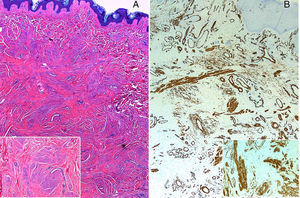 A. Epidermis hiperqueratósica bajo la que se observa una tumoración dérmica no encapsulada formada por haces entremezclados de células fusiformes y eosinófilas (H-E ×5). B. Positividad a la tinción de actina de músculo liso (×5).