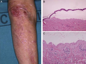 A. Variante clínica clásica: cicatrices en zonas de fricción, presencia de quistes de millium. B. Hematoxilina-eosina (×40), ampolla subepidérmica. C. Hematoxilina-eosina (×100), escaso infiltrado inflamatorio.