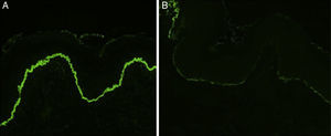 Inmunofluorescencia directa con un patrón característico de epidermólisis ampollosa adquirida (×200), depósitos lineales intensos de IgG (A) y muy tenues de C3 (B) a lo largo de la unión dermoepidérmica.