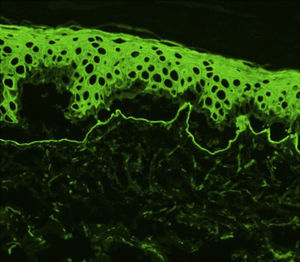 Inmunofluorescencia indirecta con piel separada con NaCl 1M (×200), los anticuerpos están dirigidos contra la parte dérmica (suelo de la ampolla).