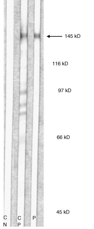 Inmunoblot con proteínas recombinantes (paciente 3). Se observa una banda de 145kD (correspondiente a la región NC1 del colágeno vii). CN: control negativo; CP: control positivo; P: suero paciente.