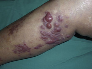 Tumores y nódulos eritematovioláceos, de consistencia elástica y de hasta 2cm de diámetro localizados en la pierna derecha de la paciente.