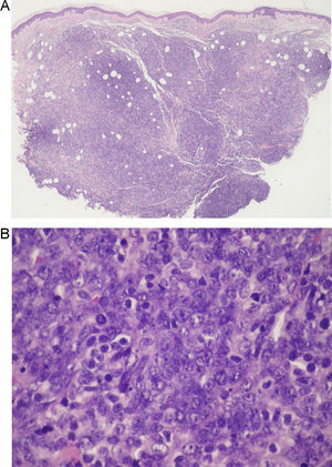 A.Infiltrado dérmico difuso, separado de la epidermis por una banda de colágeno no afectado (área Grenz) y con afectación marcada de la hipodermis (hematoxilina-eosina ×4). B. A mayor aumento puede evidenciarse que dicho infiltrado está constituido por una proliferación de células neoplásicas de tipo centroblasto e inmunoblasto, junto con algunas células de menor tamaño tipo linfocito maduro (hematoxilina-eosina ×60).