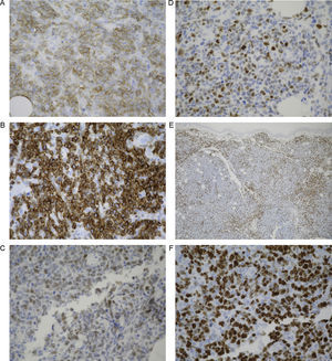A. Positividad CD20 de las células neoplásicas, componentes predominantes del infiltrado (IHQ ×40). B. Positividad intensa para bcl-2 por parte de las células neoplásicas (IHQ ×40). C. Expresión de bcl-6 en las células neoplásicas que componen en el infiltrado (IHQ ×40). D. Expresión de MUM-1 (IHQ ×40). E. Positividad para CD3 por parte de las células de pequeño tamaño acompañantes (IHQ ×4). F. Expresión de Ki-67 marcada con un índice de proliferación estimado del 90% (IHQ ×40).