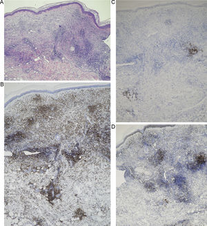 A. Infiltrado difuso compuesto por linfocitos T maduros con escasos focos de células atípicas (hematoxilina-eosina ×4). B. Expresión de CD3 por la mayor parte del infiltrado (IHQ × 4). C. Persistencia de focos de células CD20+ correspondientes a células atípicas (IHQ ×4). D. Persistencia de focos de células bcl-2+ correspondientes a células atípicas (IHQ ×4).