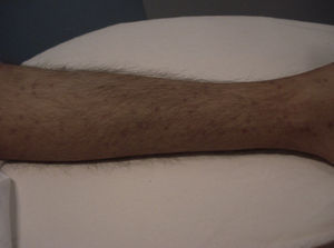 Lesiones papulosas eritemato-violáceas en las extremidades inferiores en un paciente con histoplasmosis diseminada y CD4<150 células/μl.