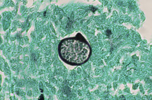 Histopatología de una biopsia cutánea que muestra microorganismos fúngicos compatibles con Coccidioides spp. (Gomori-Grocott×40).