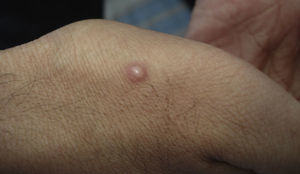 Lesión nodular de 9mm de diámetro en un paciente con criptococosis diseminada en el contexto de una infección por virus de la inmunodeficiencia humana/sida.