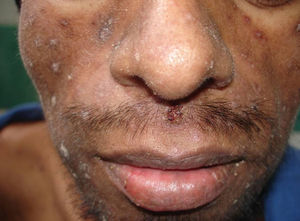 Lesiones descamativas, de predominio facial, con una zona ulcerada en el surco medio labial, en un paciente con histoplasmosis diseminada como primera manifestación de sida.