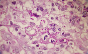 Histopatología de la histoplasmosis que muestra numerosos macrófagos con levaduras de Histoplasma capsulatum (PAS positivos) en su interior (PAS×100).