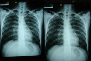 Radiografías de tórax que muestran micronódulos en el intersticio de ambos pulmones en un paciente positivo frente al virus de inmunodeficiencia humana con histoplasmosis diseminada.