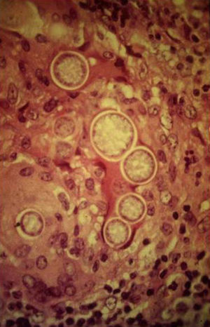 Microfotografía de una biopsia de piel que muestra esférulas redondas maduras que contienen múltiples endosporas de tamaños variables, típicas estructuras de Coccidioides spp., en tejidos infectados (hematoxilina-eosina×400).
