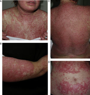 Mujer de 29 años con antecedente de epilepsia y lupus eritematoso subagudo inducido por carbamazepina de 9 años de evolución. Nótese la intensa afectación cutánea con lesiones pápulo-escamosas psoriasiformes en el tórax y en la región facial. (A) Gran afectación de los brazos y los antebrazos (B) con zonas poiquilodérmicas. Grandes placas eritemato-descamativas que comprenden toda la superficie de la espalda (C) y gran parte del abdomen. (D) Ha sido imposible retirar el fármaco debido al mal control de las crisis epilépticas con otros fármacos.