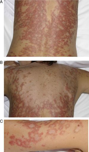 Mujer de 54 años con antecedente de epilepsia y lupus eritematoso subagudo de 2 meses de evolución tras la toma de oxcarbazepina. Lesiones eritematosas y descamativas de morfología anular en la región lumbar (A), en la espalda (B) y en los brazos (C). La sintomatología desapareció 3 meses después de suspender el antiepiléptico.
