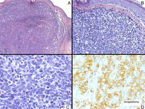 A. Tumor constituido por nidos de células poligonales (hematoxilina-eosina [H-E] × 5). B. Estas células eran irregulares y atípicas y no establecían conexión con la epidermis (H-E × 20). C. Se aprecian abundantes figuras de mitosis (H-E × 40). D. Estas células eran sinaptofisina positivas (H-E × 40).