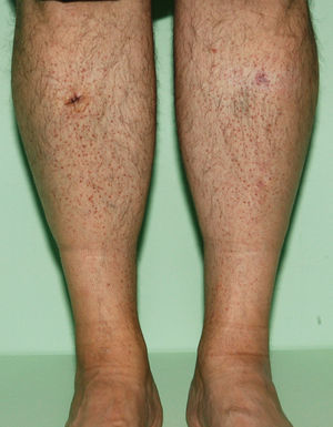 Pápulas rojizas de distribución simétrica en las piernas.