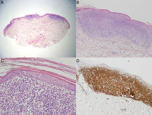 A. Infiltrados linfocíticos focales en la dermis superficial, resto de la dermis e hipodermis libre (H-E × 2). B. Detalle de infiltrado linfocítico bien delimitado en la dermis (H-E ×10). C. Linfocitos atípicos de pequeño y mediano tamaño. Visible epidermotropismo (H-E × 40). D. CD3+ en todo el infiltrado (CD3 ×10).