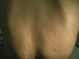 Pápulas normocrómicas con superficie arrugada localizadas en el tercio superior de la espalda, sugestivas de anetodermia.