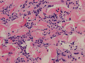 Infiltrado inflamatorio agudo con abundantes neutrófilos con patrón intersticial en la dermis reticular (HE ×200).