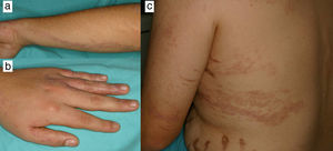 A. Erupción liquenoide lineal con disposición blaschkoide en la extremidad superior izquierda. B. Erupción liquenoide lineal en el primer, tercer, cuarto y quinto dedos de la mano izquierda. C. Erupción liquenoide lineal con disposición en «S» itálica en el hemitronco izquierdo.