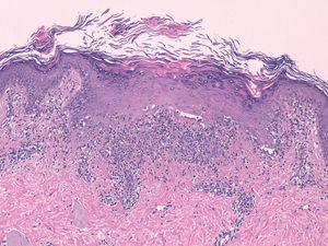 Dermatitis liquenoide: hiperqueratosis ortoqueratósica con aspecto hojaldrado, hipergranulosis focal, hiperplasia epidérmica irregular leve, borramiento de la unión dermo-epidérmica, vacuolización de la capa basal y queratinocitos necróticos (H-E × 200).