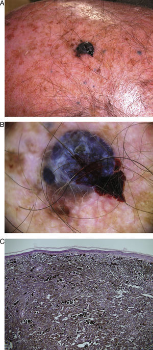 A. Nódulo pigmentado en la región parietal izquierda con múltiples satelitosis en forma de pápulas azuladas. B. Imagen dermatoscópica que muestra un patrón azul homogéneo, estructuras blanquecinas irregulares y ulceración. C. Imagen histológica de la porción central del tumor, con agregados de células epitelioides muy pigmentadas en la dermis (hematoxilina-eosina, ×40).