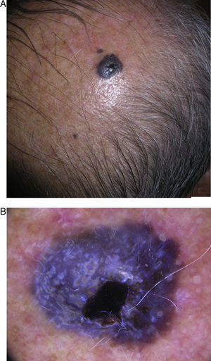 A. Nódulo negro-azulado en la región parietal derecha. B. Imagen dermatoscópica que muestra un patrón azul homogéneo, estructuras blanquecinas irregulares, ulceración y algunos vasos de gran calibre.