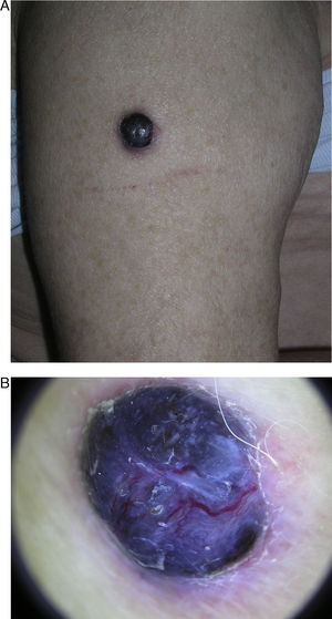 A. Nódulo pigmentado de 3cm en la cara externa de brazo derecho. B. Imagen dermatoscópica con patrón azul homogéneo, estructuras blanquecinas irregulares y vasos gruesos irregulares.