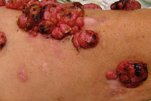 Leucodermia asociada a melanoma. Se observan múltiples máculas rosadas, además de placas hipocrómicas, algunas de aspecto cicatrizal, adyacentes a tumores de aspecto angiomatoso (metástasis de melanoma) en la cara anterior del muslo izquierdo. Este paciente ha sido previamente reportado por Salas-Alanís et al.17.