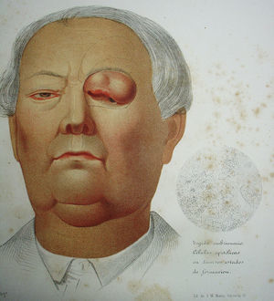 Cromolitografía del Atlas… de José Eugenio de Olavide de una lesión tuberosa y ulcerada del párpado superior operada por Federico Rubio. Se pueden intuir en el grabado los finos trazos con que marca el colgajo que talló para reparar el defecto. El estudio histológico —también de Federico Rubio— aparece en la mitad derecha. Lo describe como «tejido embrionario. Células epitélicas en diversos estados de formación».